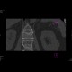 Compression fracture, second lumbar vertebra: CT - Computed tomography